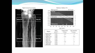 Bariatric Osteomalacia Fiona Cook MD  Internal Medicine Grand Rounds [upl. by Kalvn429]