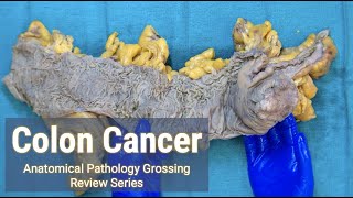 Colon Cancer  Anatomical Pathology Grossing Review Series [upl. by Neraj]