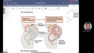 Rh Blood Group System and Haemolytic Diseases of Newborn [upl. by Whipple]