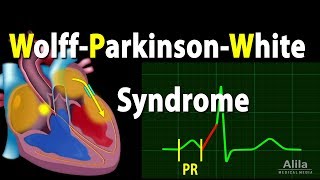 WolffParkinsonWhite Syndrome Pathophysiology PreExcitation and AVRT Animation [upl. by Nwadrebma527]