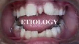 Clinical Pediatric Dentistry Etiology of Supernumerary Teeth [upl. by Megan]