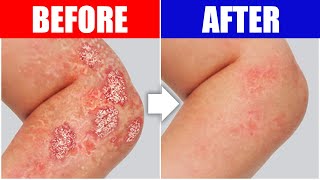 Psoriasis Relief The Best Remedy For Your Skin [upl. by Attiuqaj12]