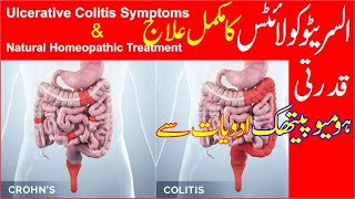 Ulcerative Colitis Treatment  Homeopathic Treatment of Ulcerative Colitis [upl. by Odnomor]