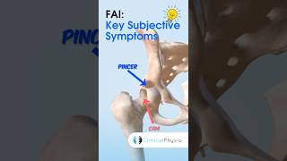 Femoroacetabular impingement FAI What Are The Key Subjective Symptoms physio physicaltherapy [upl. by Idoc]