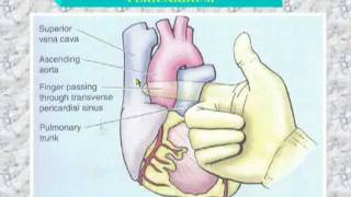 34 Transverse sinus of pericardium [upl. by Mechling952]