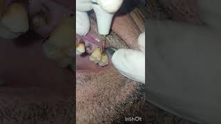 جير الاسنان ادى لانحسار اللثة  تنظيف  dentist stitch [upl. by Ajuna]