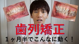 【歯列矯正】1ヶ月半でこれだけ動きました！！ [upl. by Waugh]