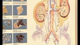 Nierensteine in der Schwangerschaft [upl. by Maryrose]