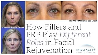 How Fillers and PlateletRich Plasma PRP Play Different Roles in Facial Rejuvenation [upl. by Feune]