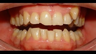 NonExtraction Therapy of Maxillary Constriction amp Severe Mandibular Crowding  Hazim 35yrs [upl. by Aseretairam]