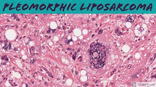 Pleomorphic Liposarcoma 5Minute Pathology Pearls [upl. by Cynthia]