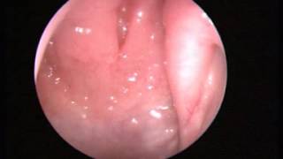 Video 1 Normal nasal endoscopy [upl. by Edwin]