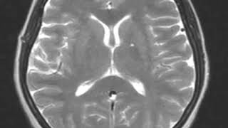 Sinus thrombosis pseudotumor cerebri and seizure disorder [upl. by Lalat587]