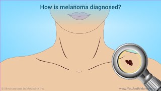 Diagnosing Melanoma [upl. by Eelik]