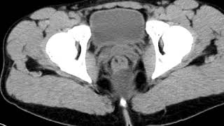 Presacral Dermoid cyst [upl. by Nepil]