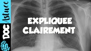 🔴 Dr Astuce  3 ANOMALIES RADIO THORAX EXPLIQUÉES CLAIREMENT  PARTIE 1 [upl. by Socram]