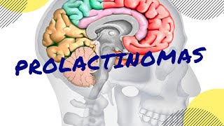 PROLACTINOMAS Causas síntomas diagnóstico y tratamiento [upl. by Joel25]