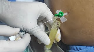 Remove abdominal fluid ascites  Paracentesis  Ascitic fluid aspiration [upl. by Annodas788]