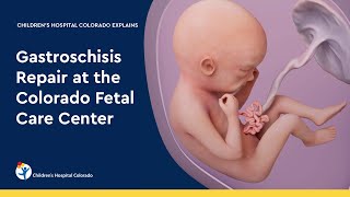 Gastroschisis Repair at the Colorado Fetal Care Center [upl. by Severen274]