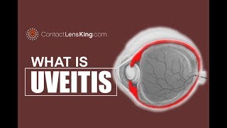 Uveitis Eye Symptoms and Causes [upl. by Ayhdnas]