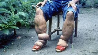 Lymphatic Filariasis Elephantiasis [upl. by Athenian]