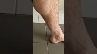 These Calf Muscle Twitches Cramps and Spasms Look Like Little Earthquakes Under the Skin [upl. by Lindon]