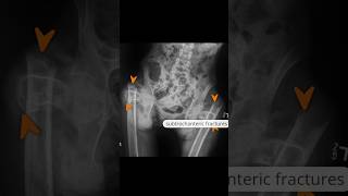 Bilateral subtrochanteric femoral fractures xray [upl. by Ashford]