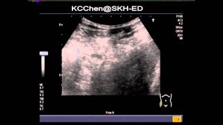 Cecal diverticulitis [upl. by Coray]