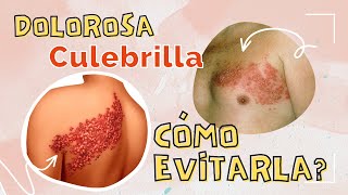 👩‍⚕️Cómo TRATAR la CULEBRILLA o HERPES ZOSTER y cómo evitar el DOLOR 😖 DESPUÉS de tenerla [upl. by Rednav602]