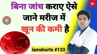 बिना जांच कराए ऐसे जाने मरीज में खून की कमी है  Anemia Shorts lamshorts [upl. by Eelik304]