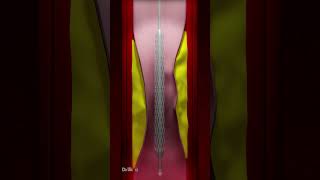 Coronary Artery Stent Placement Animation [upl. by Cristobal]