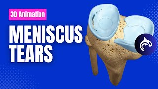 Meniscus Tears  Condition Treatment and Surgery  3D Animation [upl. by Strenta]