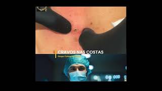 REMOVENDO CRAVOS MONSTRO NAS COSTAS 1 ‐REMOVING MONSTER BLACKHEADS ON THE BACK [upl. by Hilarius]