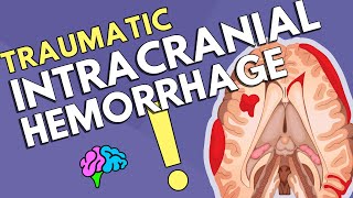 Intracranial Hemorrhage [upl. by Eenad]