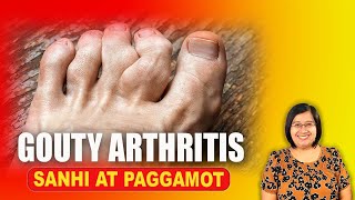 Gout Joint Pain  Arthritis Uric Acid  Bones Joints Muscles  Tagalog Health Tips  Nurse Dianne [upl. by Tamiko]