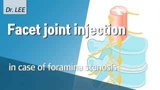 Facet joint injection in case of foramina stenosis technique and my logic lumbar spine [upl. by Birkett]