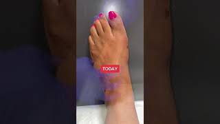 Before amp After AMI Bunion Surgery and Range of Motion [upl. by Milks]