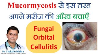 My Experience Homeopathic treatment of mucormycosis How to prevent mucormycosis in COVID patients [upl. by Oniliuqnart]