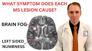 What Symptom Does Each Multiple Sclerosis MRI Lesion Cause Neurologist Explains [upl. by Okiam]