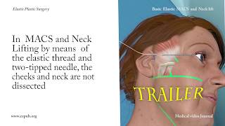 37 Basic Elastic MACS and Neck Lift without dissection of the cheeks and neck stepbystep [upl. by Oileve]