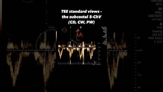 TEE standard  deep transgastric 5ChV the ascending aorta CD amp PW [upl. by Woodruff439]