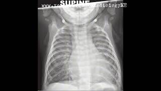 FRCR2B Case 52 Supine chest radiograph of an infant [upl. by Bradman298]