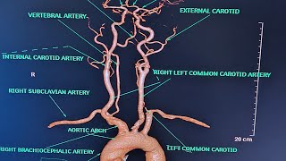 BRAIN AND NECK ANGIOGRAPHY On Ct scanALL ABOUT ANGIOGRAPHYPART1CONCEPT ON ANGIOGRAPHY [upl. by Rramal518]