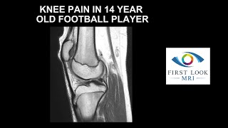 Knee pain in 14 year old football player [upl. by Merow]