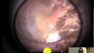 normal ear exam of the tympanic membrane [upl. by Yrogiarc]