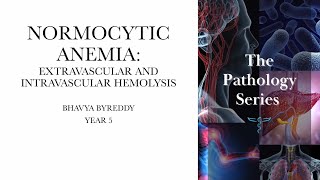 Normocytic anemia  With predominant intravascular and extravascular hemolysis [upl. by Anegroeg131]