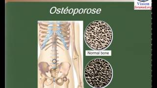 Ostéoporose définition et les facteurs de risque [upl. by Tildy]