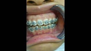 installing braces for repositioning [upl. by Vaas]