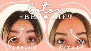 BOTOX Brow Lift before and after ✨ [upl. by Hsetirp883]