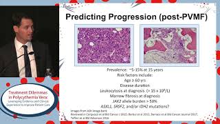 Prognostication and initiation of therapy in Polycythemia vera Do we have it right [upl. by Egedan]